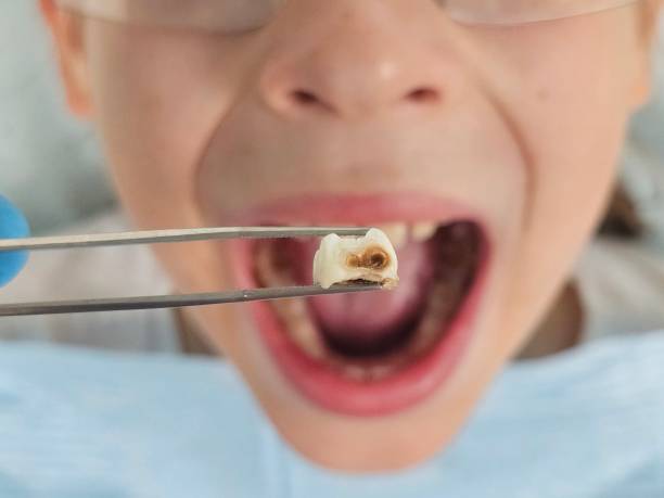 Best Emergency Tooth Extraction in Cottageville, SC